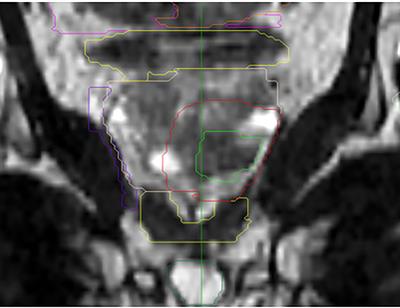 Stereotactic focal radiotherapy as an alternative treatment for low-risk prostate cancer: Results of a single-arm monocenter Phase-II trial